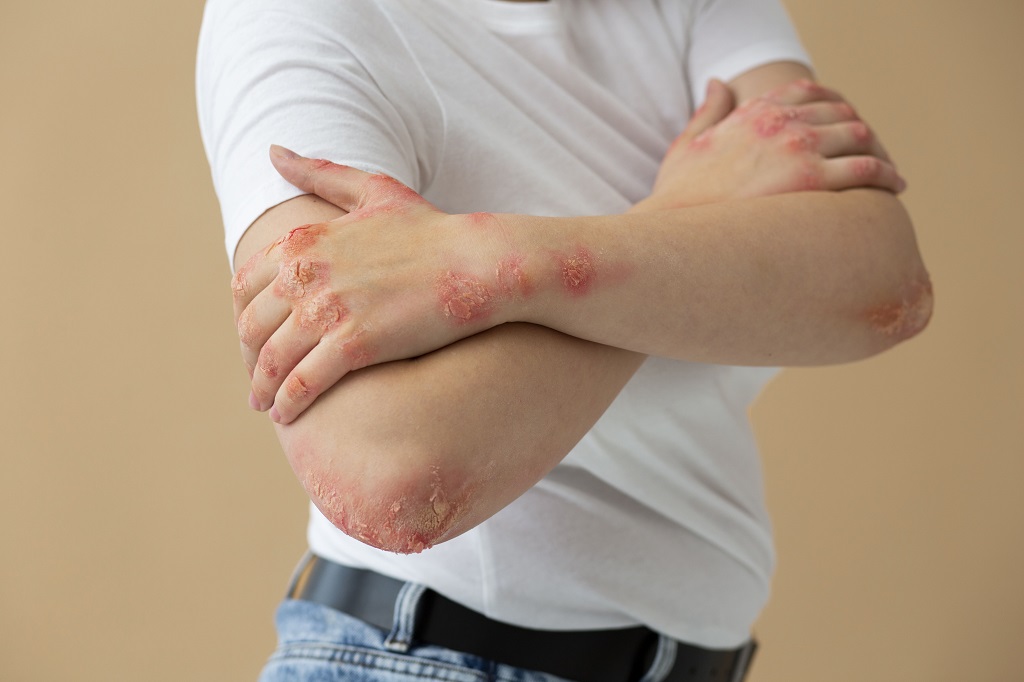 Recognizing the Signs of Lyme Disease